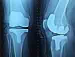 Knee joint xrays